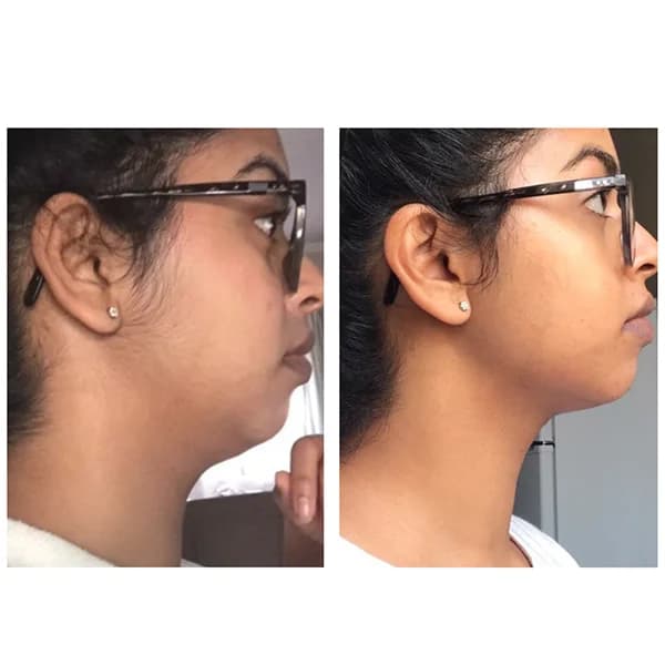 JOWLS after