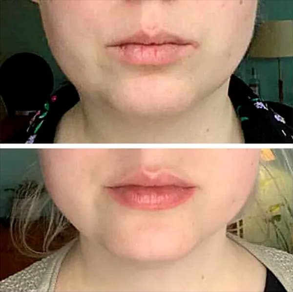 LIP LINES after