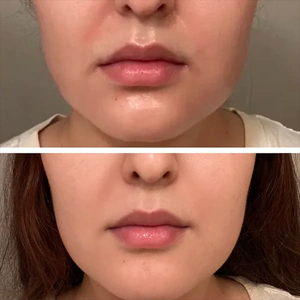 SMILE LINES after